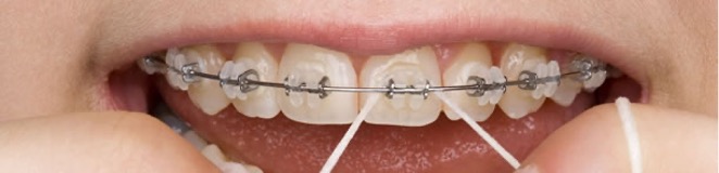 Zahnspange mit festsitzenden Keramik-Brackets.